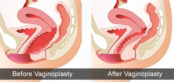 Real clinical result: before and after vaginal tightening by smart PDO threads in Riyadh — restored firmness and sensation — Dr. Dina Rezk, IAAUG fellowship-certified aesthetic gynaecologist, Al Olaya, Riyadh, Saudi Arabia