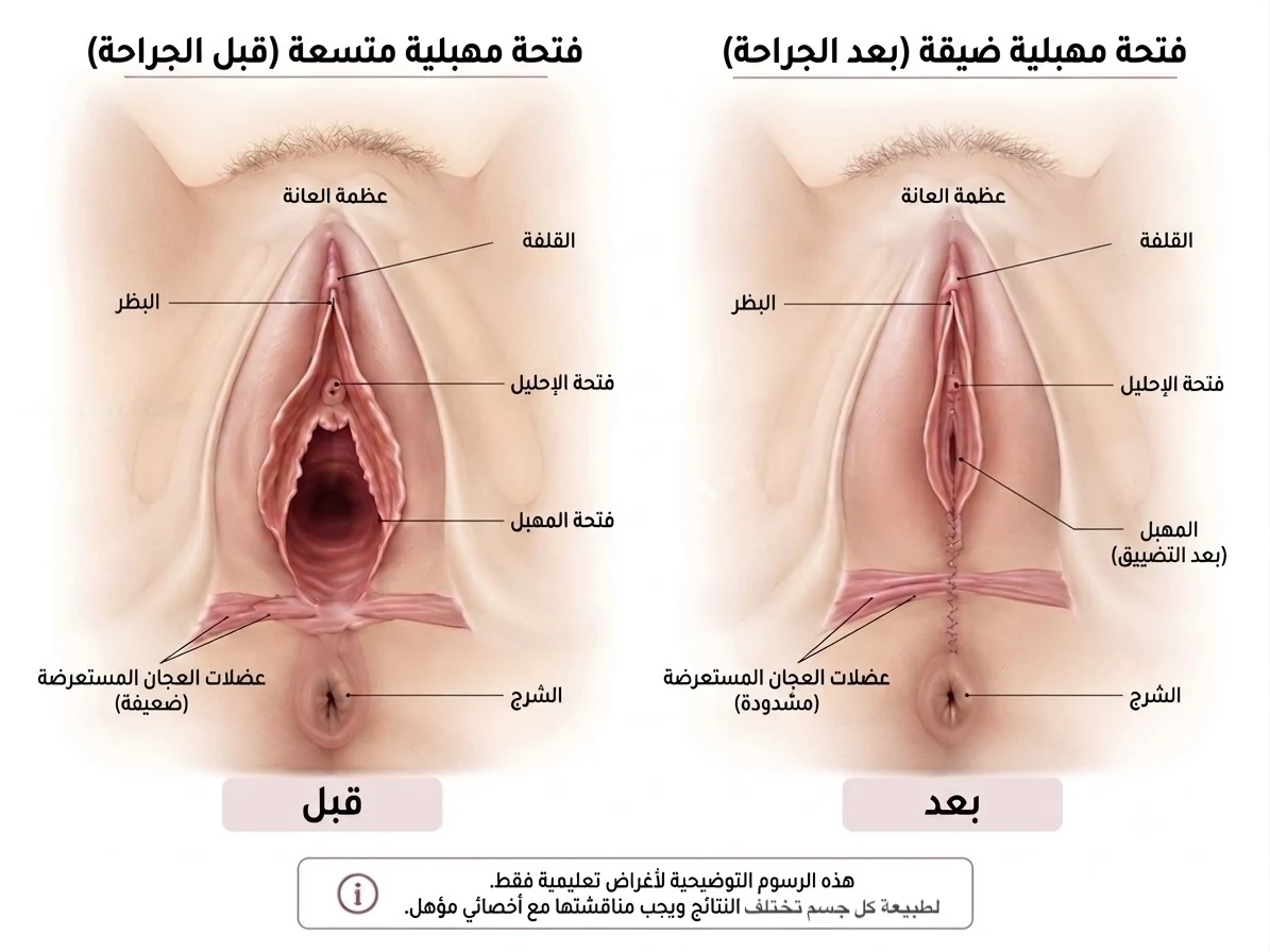صورة حقيقية: قبل وبعد عملية تضييق المهبل الجراحية في الرياض — شد القناة المهبلية وإصلاح عضلات قاع الحوض — د. دينا رزق، اخصائية التجميل النسائي، حي العليا، الرياض