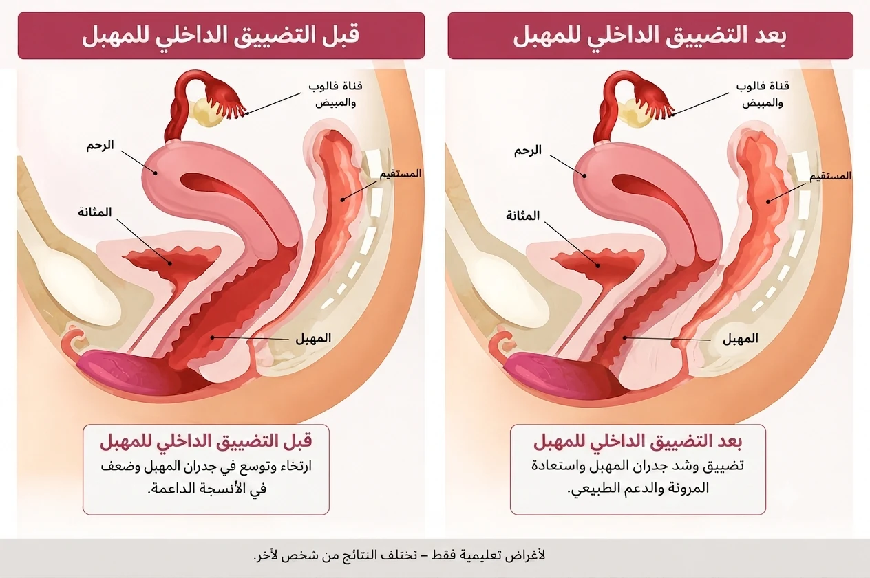 نتيجة حقيقية: قبل وبعد تضييق المهبل بالخيوط الذكية PDO في الرياض — استعادة الشد والإحساس — د. دينا رزق، اخصائية التجميل النسائي، حي العليا، الرياض، المملكة العربية السعودية