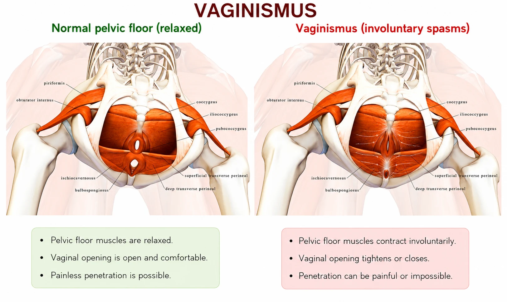 Side-by-side comparison: normal relaxed pelvic floor vs. vaginismus involuntary muscle spasm — anatomical educational diagram — Dr. Dina Rezk vaginismus specialist, Riyadh, Saudi Arabia